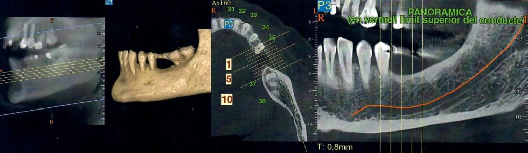 Dentalscan Orale Barcellona Dentista Dott Reato Barcellona Spagna Turismo Dentale